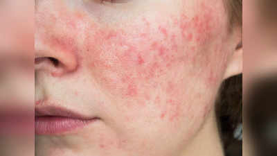 Rashes Treatment: आपके गाल पर दिख रहे लाल निशान हो सकते हैं रोजेशिया के लक्षण, घर पर न करें इसके इलाज की कोशिश