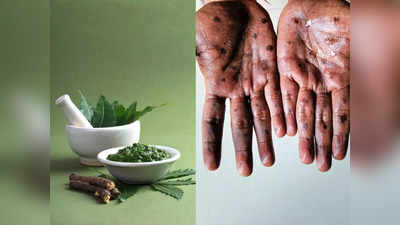 Ayurvedic treatment for Monkeypox:आयुर्वेदिक डॉक्टर ने बताए मंकीपॉक्स के लक्षणों को ठीक करने के 7 उपाय