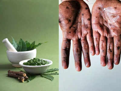 Ayurvedic treatment for Monkeypox:आयुर्वेदिक डॉक्टर ने बताए मंकीपॉक्स के लक्षणों को ठीक करने के 7 उपाय