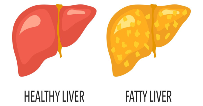 నాన్-ఆల్కహాలిక్ ఫ్యాటీ లివర్ డిసీజ్ (NAFLD)..