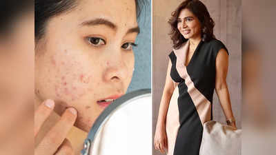 चेहरे से Pimples गायब करने हैं तो तुरंत खाना छोड़ दें डॉक्टर की बताई ये 2 चीजें, दूध से भी रहें दूर