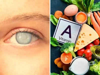 नाजूकश्या डोळ्यांना दगड बनवते Vitamin A ची कमतरता, या लोकांना जास्त धोका, ही 4 लक्षणं दिसताच व्हा सावध..!