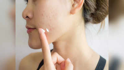 Post Pregnancy Acne: প্রেগনেন্সির পরেই কি ব্রণয় ভরে যাচ্ছে আপনার মুখ? কীভাবে ঠিক হবে, পথ দেখালেন বিশেষজ্ঞ