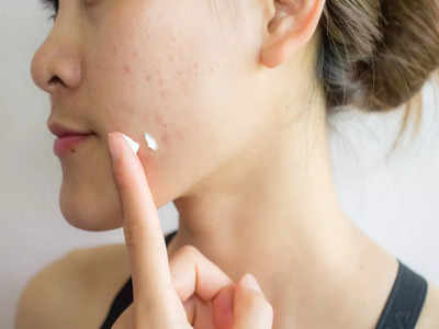 Post Pregnancy Acne: প্রেগনেন্সির পরেই কি ব্রণয় ভরে যাচ্ছে আপনার মুখ? কীভাবে ঠিক হবে, পথ দেখালেন বিশেষজ্ঞ