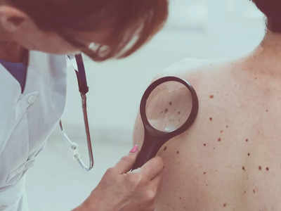 Skin Cancer | ഇത് സ്‌കിന്‍ ക്യാന്‍സറിന്റെ പ്രധാന ലക്ഷണം, അവഗണിക്കല്ലേ