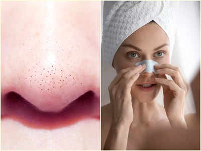 Blackheads Removal: নাকের দুপাশে ভরে যাচ্ছে ব্ল্যাকহেডস? ঘরে বসেই দূর করুন এই ৪ সহজ উপায়ে!