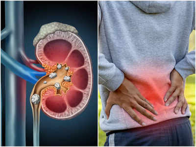 Kidney Stone Symptoms: শরীরের এই কয়েকটি জায়গায় ব্যথা হল কিডনি স্টোনের লক্ষণ! চিকিৎসকের পরামর্শে সতর্ক হলে এড়ানো যায় অপারেশন