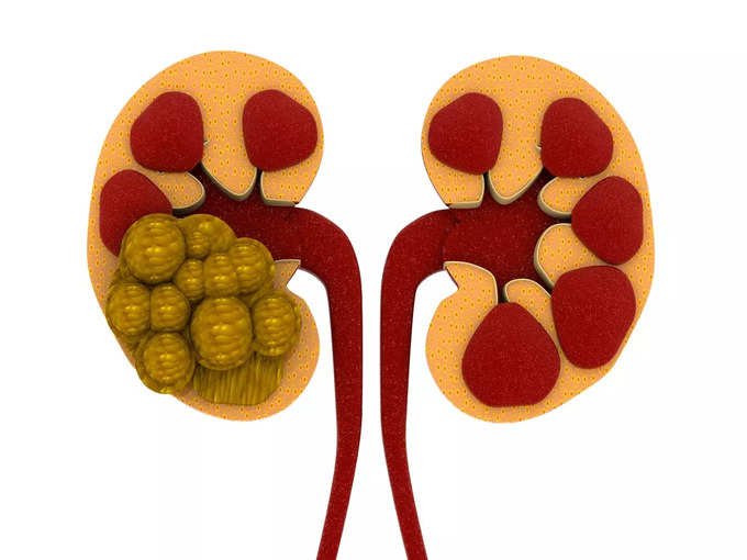 ​রোগ নির্ণয় কী ভাবে? (Kidney Stone Test)