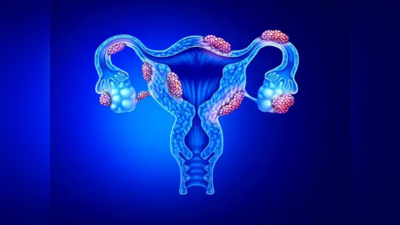 Fibroids treatment: సర్జరీ లేకుండా..  ఫ్రైబ్రాయిడ్స్‌ను ఇలా తగ్గించుకోవచ్చు..!