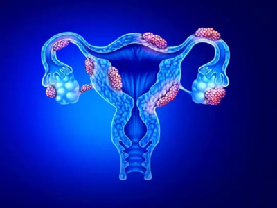 Fibroids treatment: సర్జరీ లేకుండా..  ఫ్రైబ్రాయిడ్స్‌ను ఇలా తగ్గించుకోవచ్చు..!