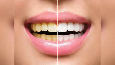 Teeth whitening: पीले-बदबूदार दांतों को छिपाने की नहीं जरूरत, डेंटिस्ट के 5 उपाय बनाएंगे सफेद और मजबूत