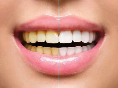 Teeth whitening: पीले-बदबूदार दांतों को छिपाने की नहीं जरूरत, डेंटिस्ट के 5 उपाय बनाएंगे सफेद और मजबूत