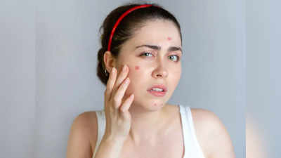 Acne Treatment:ચહેરાનો એક ભાગ ખીલથી ભરાઇ ગયો છે? ડર્મેટોલોજીસ્ટ અનુસાર આ 4 આદત બદલવાથી મળશે રાહત