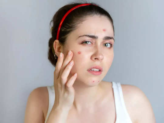 Acne Treatment:ચહેરાનો એક ભાગ ખીલથી ભરાઇ ગયો છે? ડર્મેટોલોજીસ્ટ અનુસાર આ 4 આદત બદલવાથી મળશે રાહત 