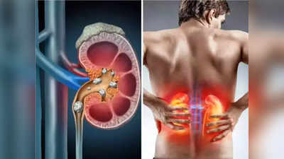 How to Pass Kidney Stones Fast: किडनी स्टोन किंवा मुतखडा अगदी मेणासारखा गळून पडेल, करा फक्त हे 5 घरगुती उपाय.!