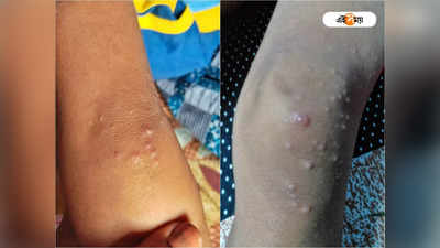 Monkeypox: মাঙ্কিপক্সের উপসর্গ একাধিক খুদের, দুর্গাপুরে ব্যাপক আতঙ্ক