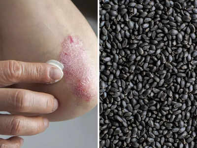चर्म रोग Eczema और Psoriasis का रामबाण इलाज हैं ये काले बीज, जानिए कैसे करें इस्तेमाल