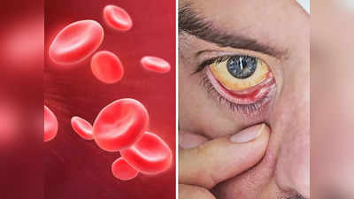 Anemia symptoms: आंखों में ही दिख जाएगा शरीर में खून की कमी का ये लक्षण, Iron-Hemoglobin बढ़ाएंगी ये 8 चीजें