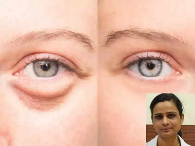 puffy eyes : கண்ணுக்கு கீழ் வீக்கமா... பட்டுனு சரியாகிடும்.. ஆயுர்வேத நிபுணர் சொல்வதை கேளுங்க!