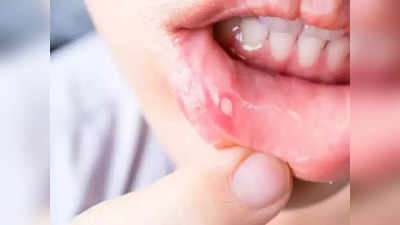 mouth cancer : உங்க உதட்டுல இந்த மாற்றம் இருந்தா அது புற்றுநோய் அறிகுறியா இருக்கலாம். அலட்சியம் செய்யாதீங்க!