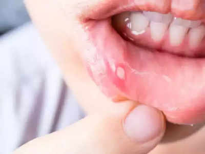 mouth cancer : உங்க உதட்டுல இந்த மாற்றம் இருந்தா அது புற்றுநோய் அறிகுறியா இருக்கலாம். அலட்சியம் செய்யாதீங்க!