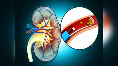 Acute Pyelonephritis: पथरी से भी दर्दनाक है यह रोग, किडनी-पेशाब की नली को करता है डैमेज, समझें इसके 8 लक्षण