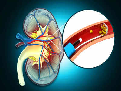 Acute Pyelonephritis: पथरी से भी दर्दनाक है यह रोग, किडनी-पेशाब की नली को करता है डैमेज, समझें इसके 8 लक्षण