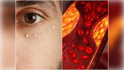Cholesterol Symptoms in Eyes: আপনার চোখেই লুকিয়ে আছে ঘাতক হাই কোলেস্টেরলের লক্ষণ! দেখেই বোঝার উপায় জানালেন চিকিৎসক