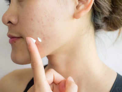 Acne Remedies: പ്രസവ ശേഷം വരുന്ന മുഖക്കുരുവിന് പരിഹാരം