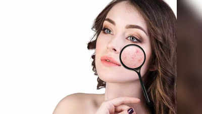 acne on face : முகத்தின் ஒரு பக்கத்தில் மட்டும் பரு அதிகமாக இருக்கா... சரிசெய்ய இதனை செய்தாலே போதும்..!