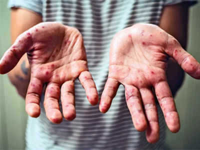 Hand, Foot And Mouth Disease: નાના બાળકોને થતા આ રોગના કેસમાં પાછલા કેટલાક દિવસોમાં થયો છે વધારો