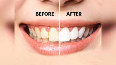 Teeth Whitening Solution :​ ​दांतों पर जमी बत्तीसी और पीलेपन को करना है दूर, तो इन 5 पाउडर से मिलेगी काफी मदद