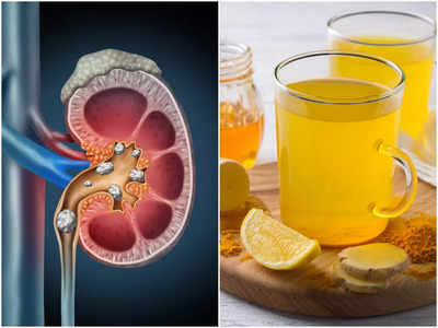 Kidney Stones Diet: এই ৫ শরবত বানিয়ে খেলেই কিডনি স্টোন গলে বেরিয়ে যায়, সন্ধান দিলেন বিশিষ্ট পুষ্টিবিদ