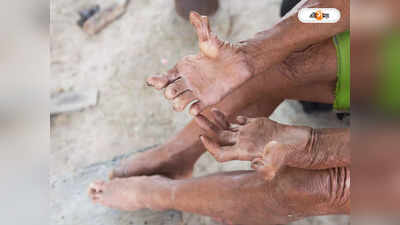 Cooch Behar News: কুষ্ঠ রোগীদের খোঁজ পেতে বাড়ি বাড়ি সমীক্ষা শুরু করল স্বাস্থ্য দফতর