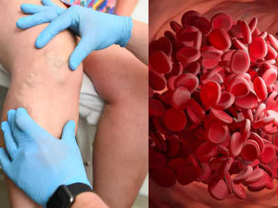 પ્રતિ વર્ષ 1 લાખ લોકો Blood clottingથી જીવ ગુમાવે છે; એક્સપર્ટ્સ પાસેથી જાણો તેના કારણો, લક્ષણો અને અટકાવવાની રીત