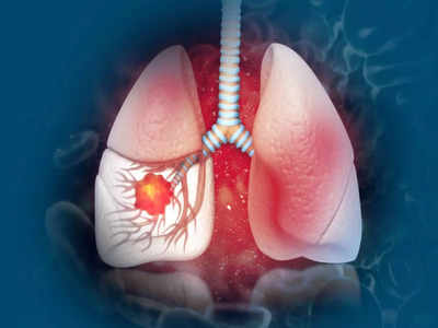 Lung Cancer: లంగ్‌ క్యాన్సర్‌ ఉంటే.. ఈ లక్షణాలు కనిపిస్తాయంట..!