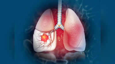 Lung Cancer: లంగ్‌ క్యాన్సర్‌ ఉంటే.. ఈ లక్షణాలు కనిపిస్తాయంట..!