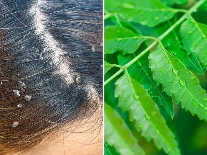 6 easy and effective ways to use neem leaf to get rid dandruff without medical treatment