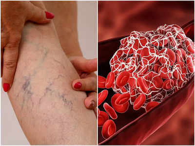 Blood Clot Symptoms: অজান্তেই রক্তনালীতে জমাট বাঁধে রক্ত, এই ৫ লক্ষণকে হালকা নিলেই প্রাণঘাতী হবে পরিস্থিতি