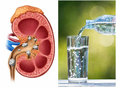 Causes of Kidney Stone: আপনার এই সাধারণ ভুলেই কিডনিতে পাথর জমে আকারে বাড়ছে, সতর্ক করলেন চিকিৎসক