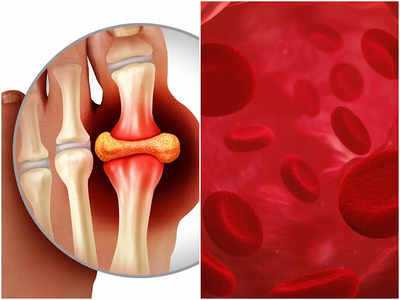 Uric Acid Affects Joints: বেছে বেছে এই জয়েন্টগুলিতে আক্রমণ চালায় Gout, যন্ত্রণা করলেই সতর্ক হতে বললেন চিকিৎসক