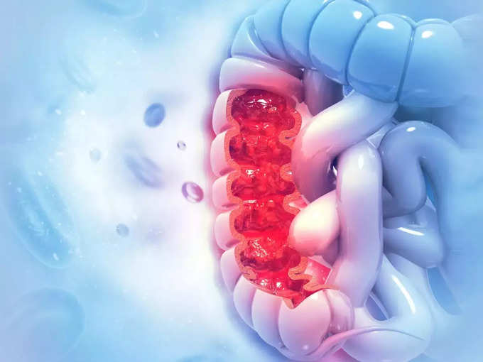 ​பெருங்குடல் புற்றுநோய்க்கான ஆபத்துகள் அதிகம்