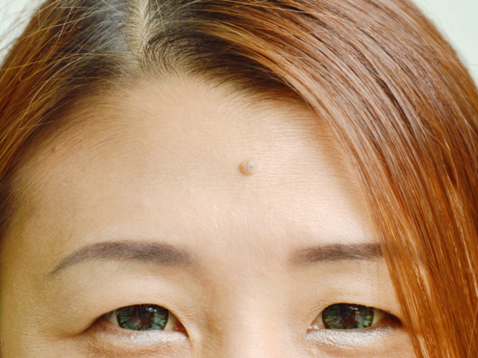 ​நெற்றியில் மச்சம் (mole on forehead)