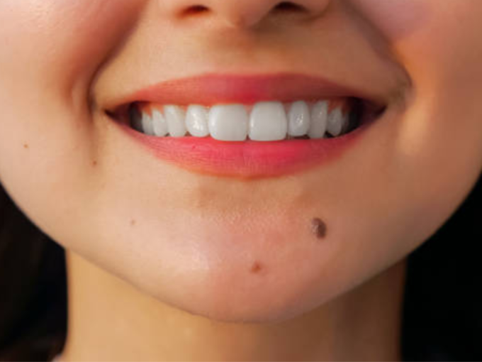 ​தாடையில் மச்சம் (mole on chin)