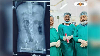 Burdwan Medical College: অবিশ্বাস্য, জটিল অস্ত্রোপচারে যুবক পেট থেকে বের হল ডিওড্রেন্টের বোতল!