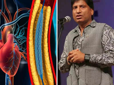 राजू श्रीवास्तव यांची झाली होती Angioplasty, डॉ.कडून जाणून घेऊया बंद नसांना मोकळं करणारी सर्जरी किती परिणामकारक