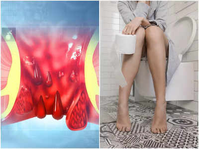 Causes of Piles (Hemorrhoids): এই ৫ সাধারণ কারণেই অর্শের জ্বালায় নিত্যদিন ভুগছেন, জানুন চিকিৎসকের কাছে