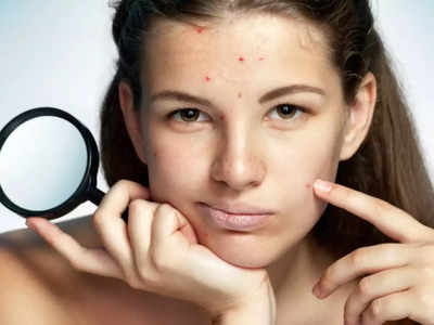 acne problem : பீரியட்ஸ் வந்தாலே பருவும் கூட சேர்ந்து வருதா... ரெண்டு நாள் முன்னாடியே இத அப்ளை பண்ணுங்க... வராது...