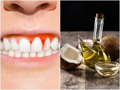 Bleeding Gums Home Remedies: মাড়ি থেকে বের হয় রক্ত? এই সহজ উপায়ে মিলবে চটজলদি রেহাই