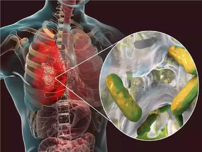 Water in Lungs: बापरे, ही 15 लक्षणे दिसल्यास समजून जा फुफ्फुसांत भरलंय पाणी, सुकवण्यासाठी करा हे 6 घरगुती उपाय